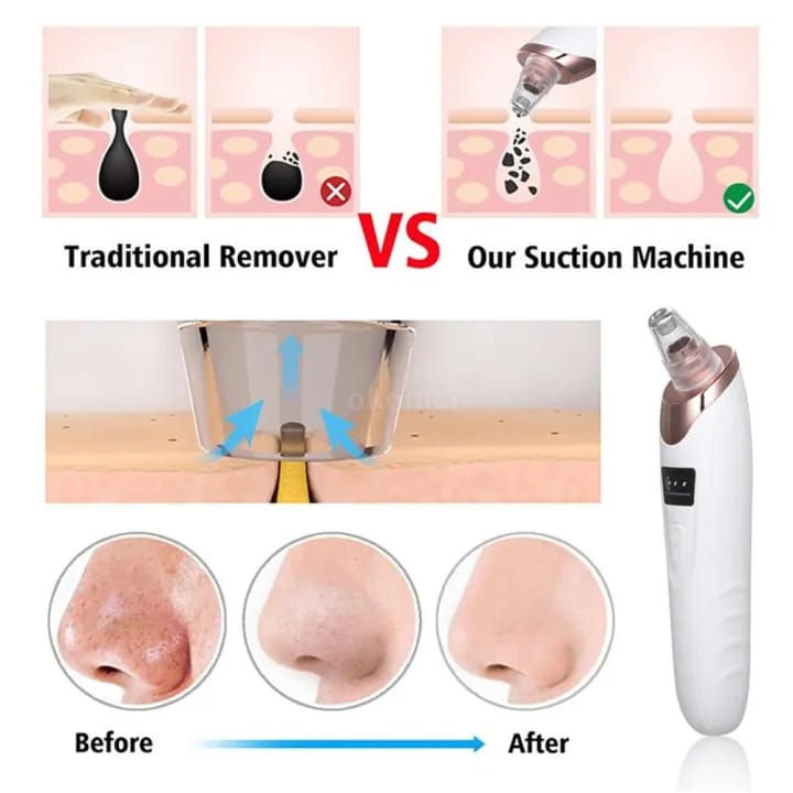 Vaccum Blackhead Remover